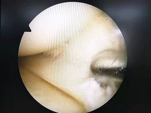 【永医前沿】骨科自主完成关节镜下膝关节骨性关节炎关节清理＋半月板成形术！