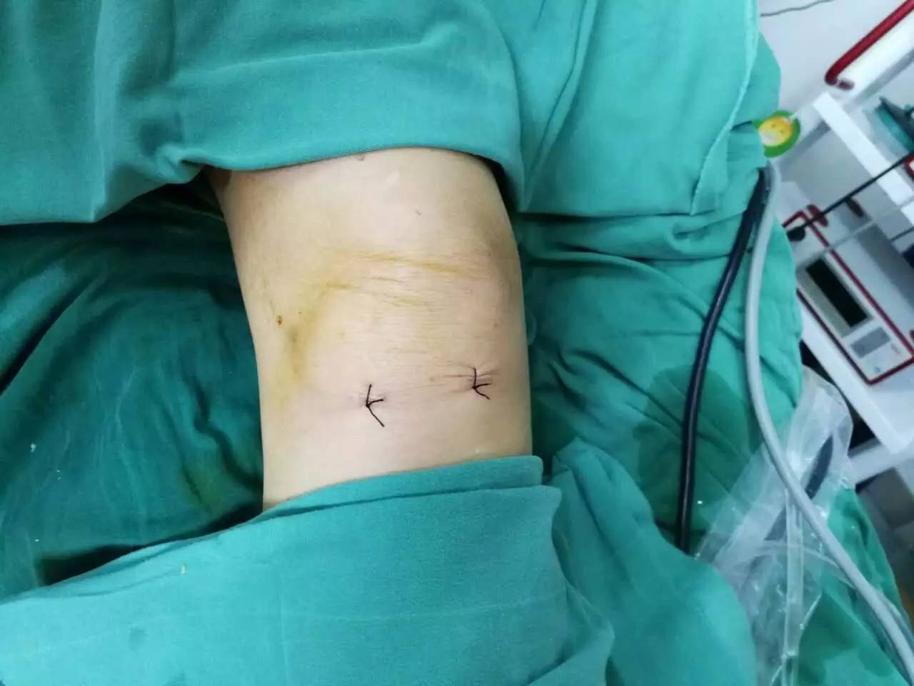 【永医前沿】骨科自主完成关节镜下膝关节骨性关节炎关节清理＋半月板成形术！