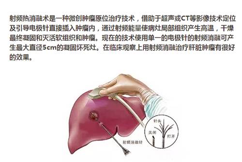 【永医前沿】外三科顺利完成“CT定位下肝肿瘤射频消融手术”！