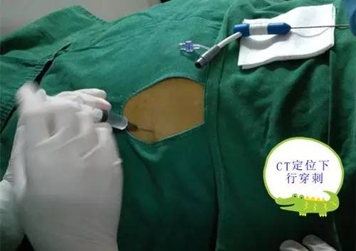 【永医前沿】外三科顺利完成“CT定位下肝肿瘤射频消融手术”！