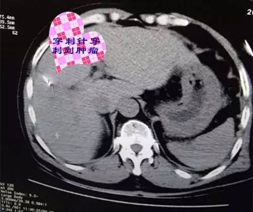 【永医前沿】外三科顺利完成“CT定位下肝肿瘤射频消融手术”！