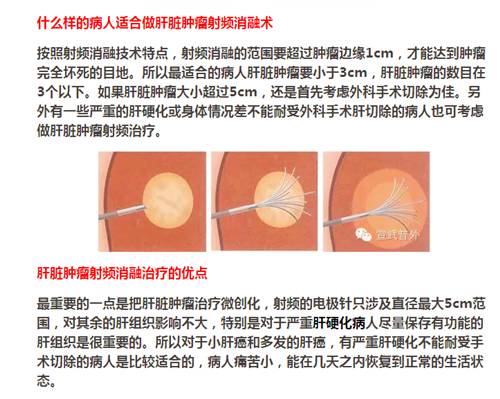 【永医前沿】外三科顺利完成“CT定位下肝肿瘤射频消融手术”！